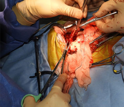 胆嚢摘出手術における血管クリップでの処理